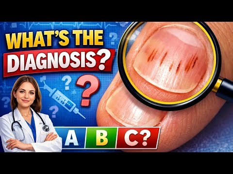 Splinter Haemorrhage || Clinical Finding & Diagnosis || Medicine || Education || Dr Medica ||