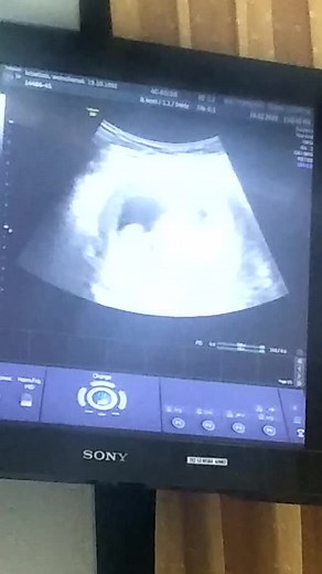 Ultrasound Images of Early Pregnancy Development
