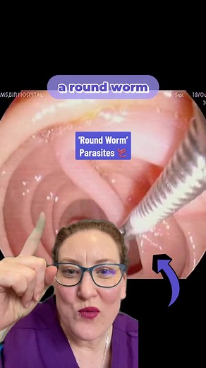 Understanding Round Worm Parasites in Colonoscopy