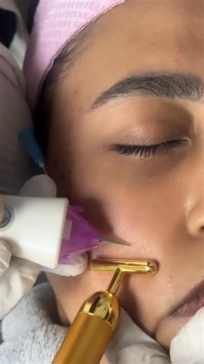 Alizeh Jamali on Instagram: "Sorry for making you all wait Results from my treatment a few week ago 🤍 Subcision + Cold Plasma + Collagen Molecule for my pitted scars. Thank you Aesthetic Essence Skin and Hair Clinic can’t wait for the follow-up ✨ . #alizehjamali #viral"