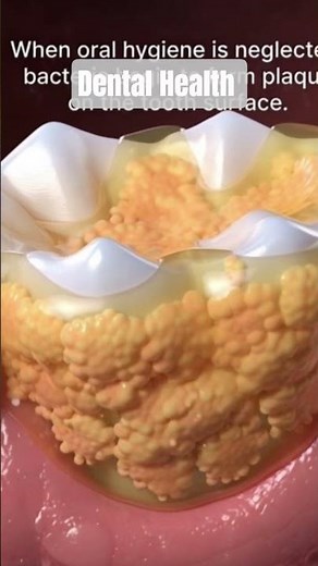 What Is Dental Scaling? 3D Animation of Plaque & Tartar Removal