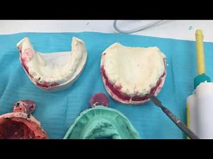 Visit 2: Management of large undercuts during secondary impressions