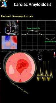 Strain Echo (speckle tracking) Patterns