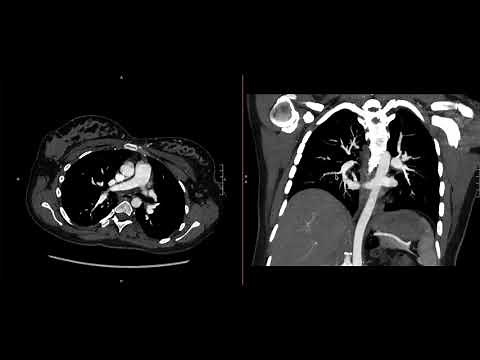 Tracing Pulmonary Arteries Systematically