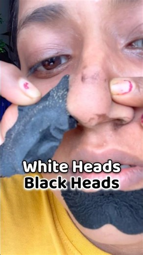 White heads Removal from Nose | white head black head re￼moval at home | white head black head mask