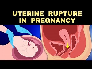 Uterine Rupture during Pregnancy : What to Know !