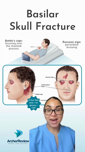 A basilar skull fracture happens when there is a fracture 🚫 to the base of the skull 💀 where it connects to the spinal cord. This type of skull fracture results in some very specific assessment findings 🔍 that are important to know for nursing school and the Next Generation NCLEX! Three big ones to know are: ⚔️ Battle's sign: bruising over the mastoid process 🦝 Raccoon sign: periorbital bruising 💧 Cerebrospinal fluid (CSF) draining from nose/ears ✨NCLEX TIP✨ We NEVER insert anything into th