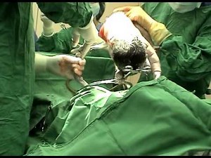 帝王切開でお腹から出た瞬間に開創器を握った赤ちゃん。The baby grasped the forceps.