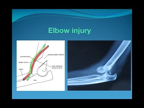 Elbow injury (Supracondylar fracture and elbow dislocation)