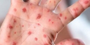 Doctor urges testing after measles exposure at Heritage Bank Center