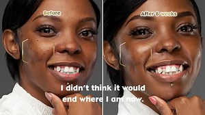 After 8 weeks of using the NIVEA Luminous630 Anti-dark marks serum @adelleonyango is excited to say that it works. She has seen visible fading of her dark marks and is ready to recommend it to friends and family. Have you joined the #Luminous630Challenge? Share with us your experience so far. | NIVEA