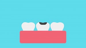 Tooth Extraction Animation Removing Cavity Tooth Stock Footage Video (100% Royalty-free) 3815412709 | Shutterstock