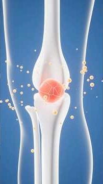 Understanding Fixators in Orthopedic Surgery