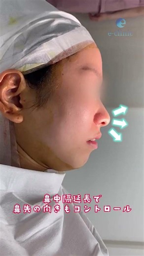 【クローズド法でここまでできる】視野が限られた鼻整形で、理想通りのデザインを実現する技術