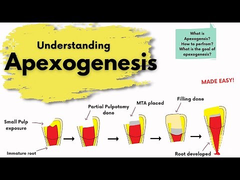 Apexogenesis | What is it? | Endodontics