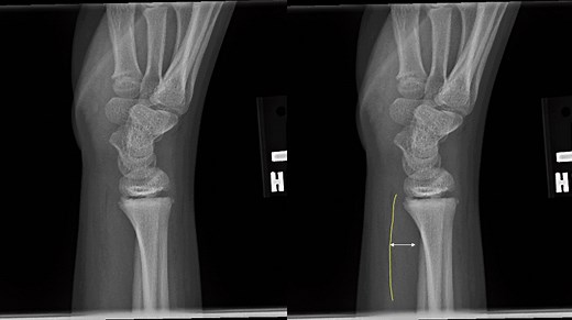 Pronator Quadratus Sign