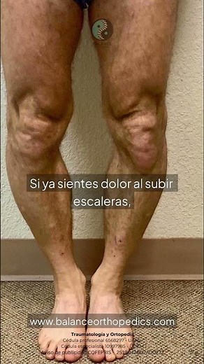 ¿Tus rodillas están alineadas? 🦴🦵