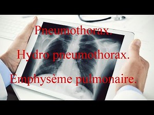 Pneumothorax - Hydro pneumothorax - Emphysème pulmonaire