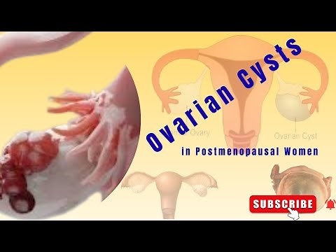 The Management of Ovarian Cysts in Postmenopausal Women | RCOG Guideline | GTG