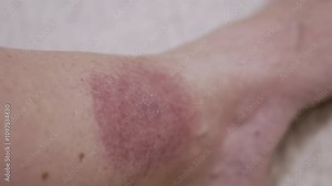 Close up, Formation of a Large Red Spot on the Skin from a Tick Bite. Irritation, itching, swelling, infection, redness around skin of leg. Lyme disease. Insect, mosquito, encephalitis tick bite.
