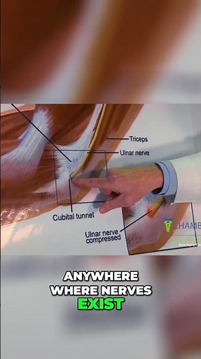 Elbow & Wrist Nerve Pain What You NEED to Know NOW!