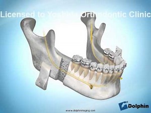 Mandibular Setback