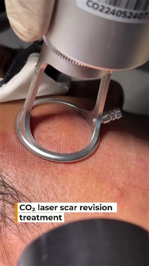 7.9K views · 11 reactions |  What is CO₂ Laser Scar Revision? It’s...