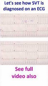 Let's see how SVT is diagnosed on an ECG