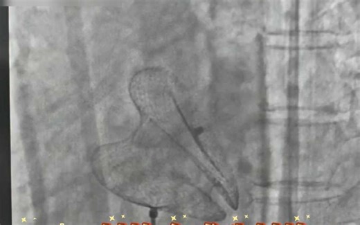 先心病房间隔缺损（ASD）介入封堵 42mm封堵伞成功封堵