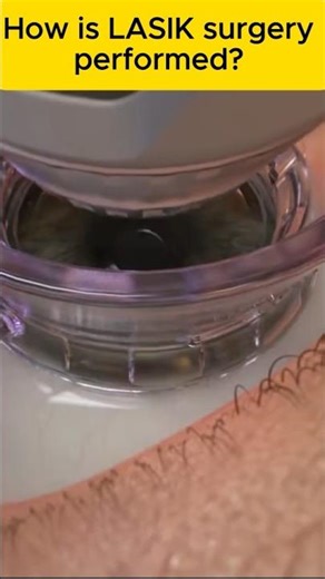 How LASIK Laser Eye Surgery Works!