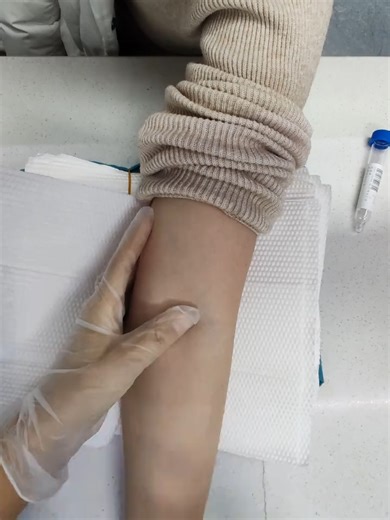 Mastering the Flying Needle Technique for Blood Draws