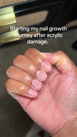 Nail Growth Journey After Acrylic Damage