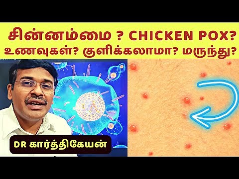Chickenpox: Causes, Symptoms, and Prevention | சின்னம்மை