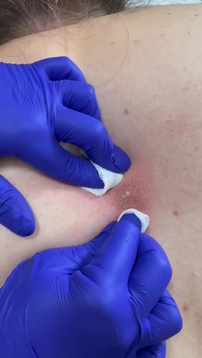 Extractions 😍 #extractions #pimplepop #pimplepopper #viralvideo #viraltiktok #pop #pimple #pimples #adamandevelaserandbeauty#sydneyaustralia #beautytok