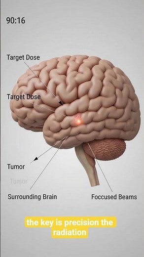 Gamma Knife: Brain Surgery Without Cutting? 🧠#GammaKnife #BrainTumor #Neurosurgery