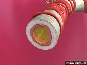 Understanding Asthma - 360p [Animation] on Make a GIF