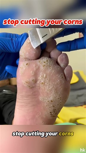 Effective Methods for Treating Corns and Calluses