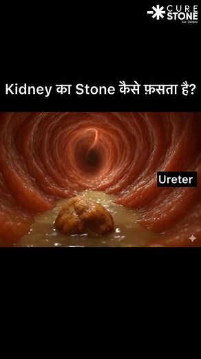 17K views · 387 reactions | When a kidney stone reaches the narrowest...