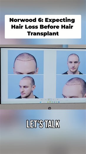 Understanding Hair Loss and Its Treatments