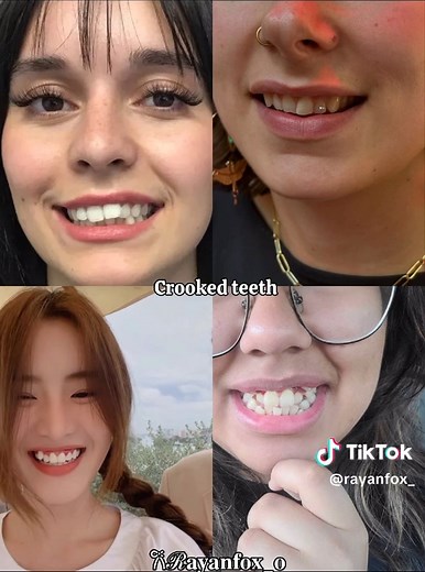 Understanding Crooked Teeth and Their Impact