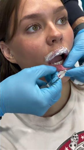 Lip Filler Touch Up with the Swift Technique | Painless & Natural Results by Dr. Dahabra #shorts