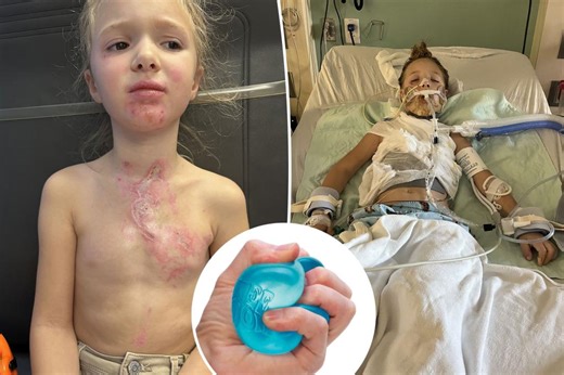 Girl, 7, in coma with horrific burns after TikTok challenge causes toy explosion