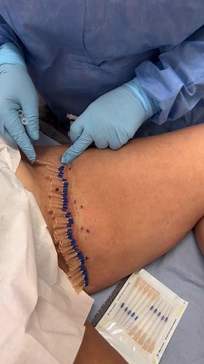 Mono threads for tightening and rejuvenating inner thighs 🪡 #pdo #pdothreadlift #monothread #monothreadlift #rejuvenation