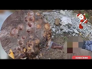 JIGGER REMOVAL - Extreme Jigger Nest – Crawling Under Skin! #HB2561