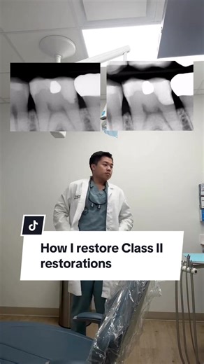 Restoring Class II Dental Restorations Techniques