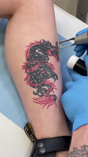Laser tattoo removal, first session. We hit the red after this, but that laser leaves permanent little green dots on the camera sensor ⚡️ Professional laser tattoo removal in Kelham Island, Sheffield #lasertattooremoval #satisfying #sheffield