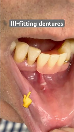 Ill-fitting dentures