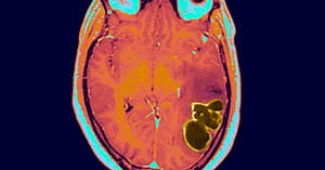 Bruce Willis' aphasia diagnosis