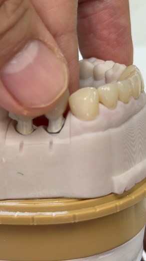 9.1K views · 76 reactions | Esthetics restorations from Custom mini syton hybrid implants! From Dr.Joseph Rigg in South Dakota | Luke Kahng | Facebook