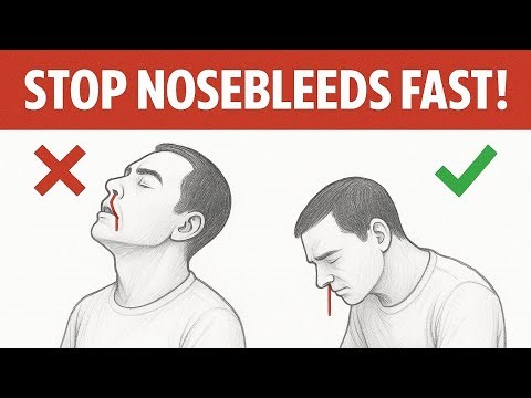 Stop Nosebleeds in 2 Minutes!